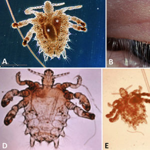 Lice examples with corresponding letters