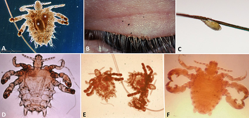 Lice examples with corresponding letters