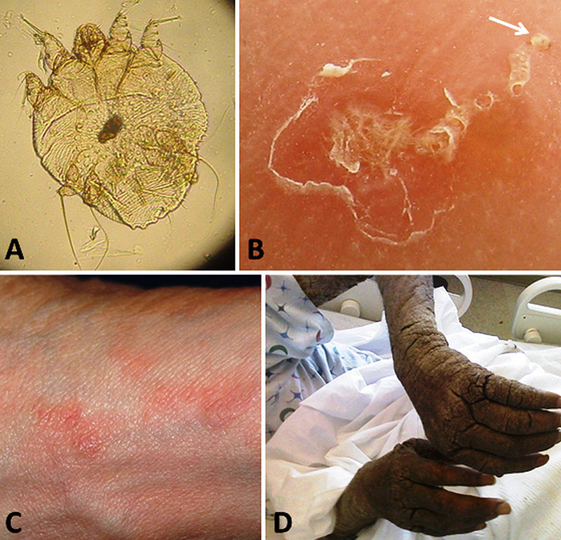 Scabies examples with corresponding letters