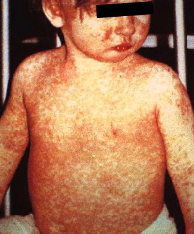 Child with rash on arms chest and face